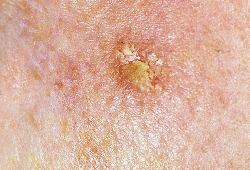 dermnet_photo_of_actinic_keratosis_on_face